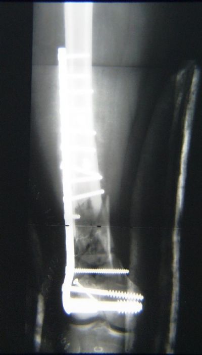 Dynamic Condylar Screw (Implant 288)